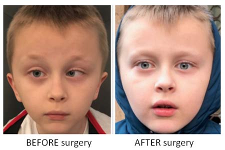 strabismus surgery side effects