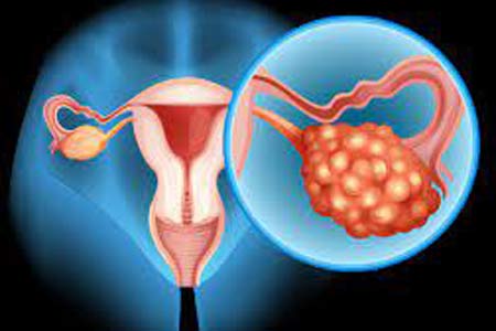 ovarian cancer treatment side effects