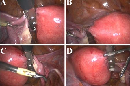 Uterus Removal Surgery Types