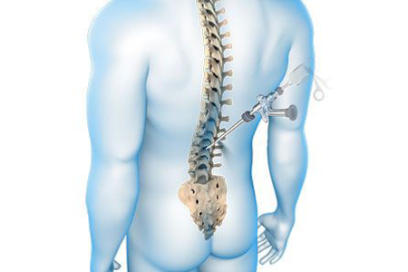 Spine Surgery in India