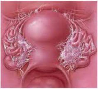 pelvic adhesiolysis surgery before and after