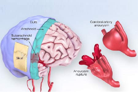 brain aneurysm surgery types