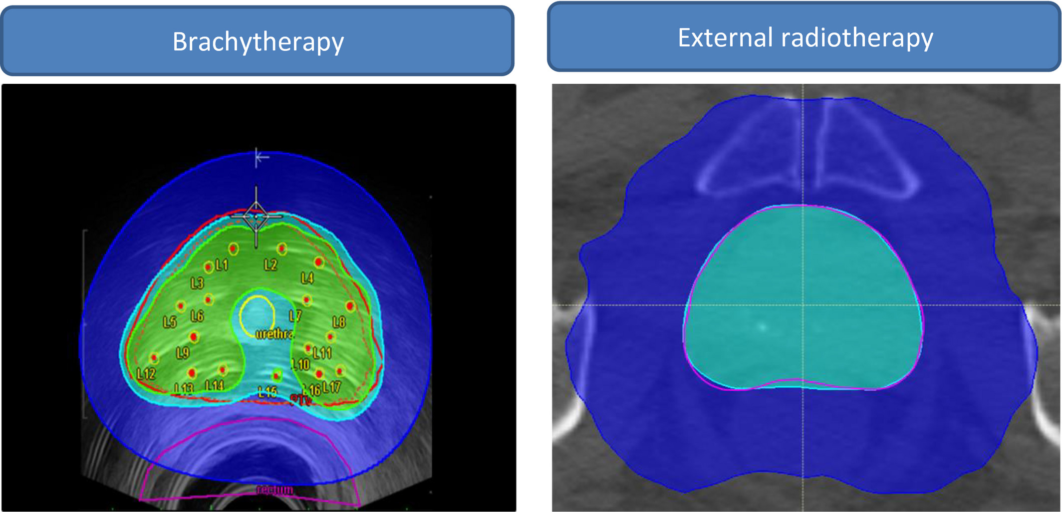 Focused radiation: Brachytherapy's localized approach to cancer therapy