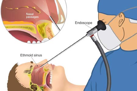 sinus surgery types