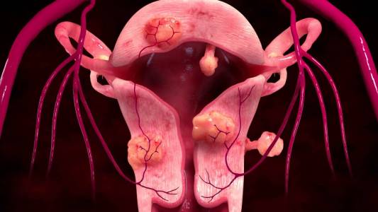 Uterine Fibroid Embolization Surgery in India