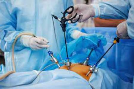 Low cost of fibroids surgery in India