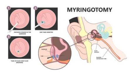 Myringotomy in India