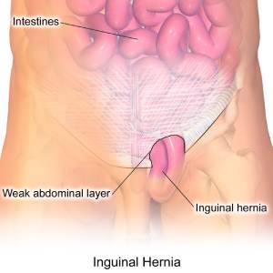 Hernia Surgery Cost in India