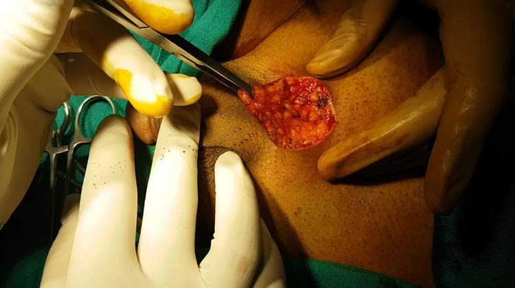 Penis Enlargement Surgery in India