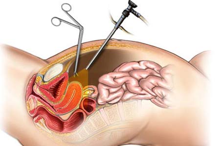 Uterus Removal Surgery in India