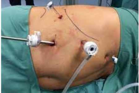 Adrenalectomy  in India