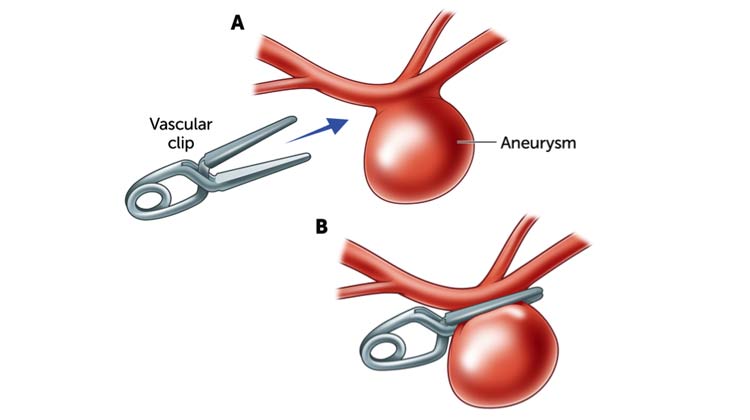 Aneurysm Surgery in India