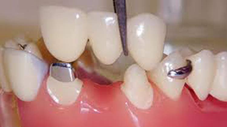 Dental Crown Treatment in India