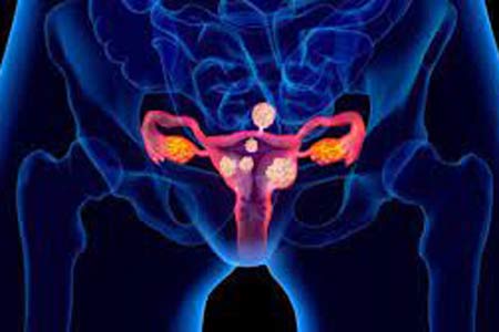 fibroids treatment types