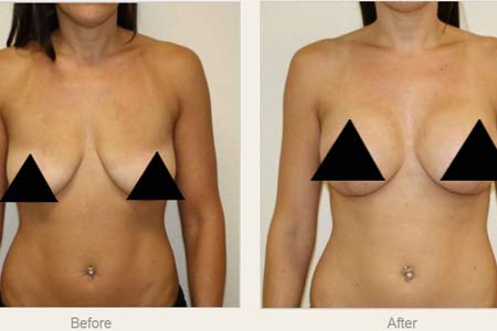 breast lift surgery side effects
