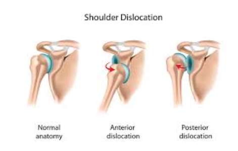 Shoulder Dislocation Surgery before and after