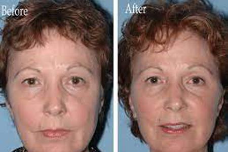 facelift surgery types