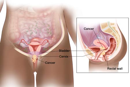 Cervical Cancer 