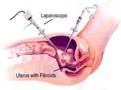 Affordable cost of fibroids surgery in India