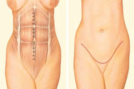tummy tuck surgery before and after