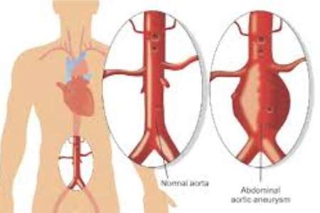 Affordable Aortic Aneurysm Surgery Cost in India
