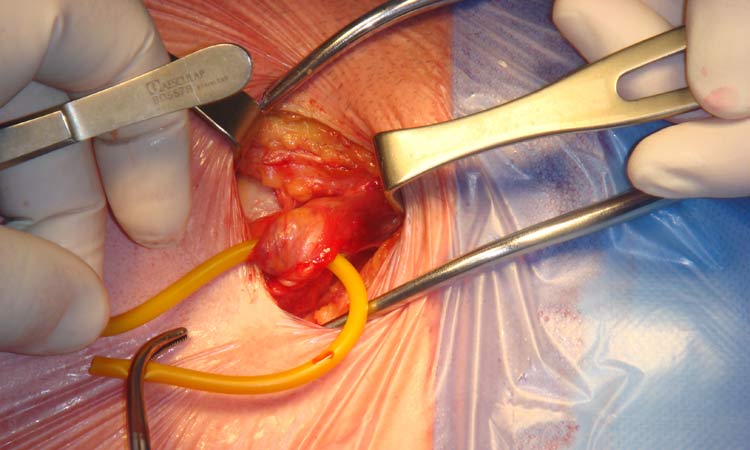 Hernia Surgery Cost in India