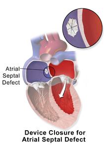 Atrial Septal Defect Closure Surgery