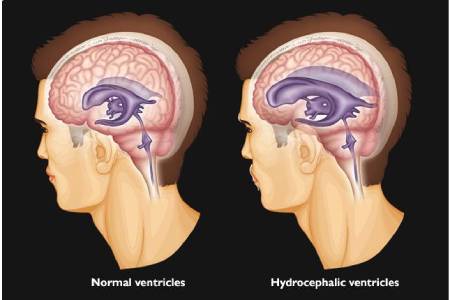 Low cost of  Hydrocephalus Surgery