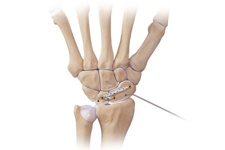 Wrist Instability Treatment Cost