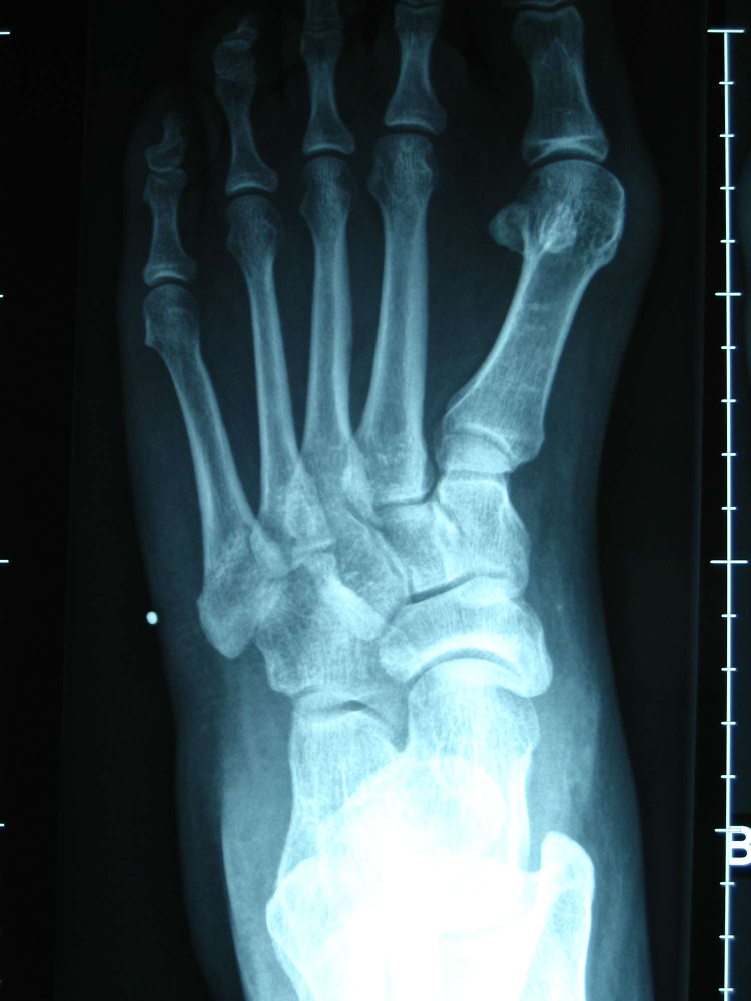 X-ray image showing misalignment of the big toe joint in a bunion