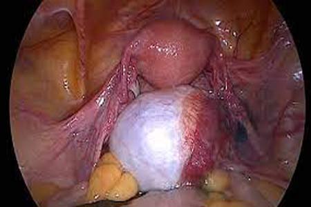 ovarian cyst removal surgery before and after