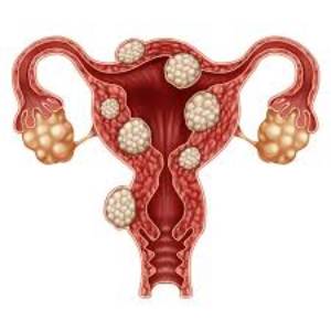 uterine fibroid embolization surgery side effects