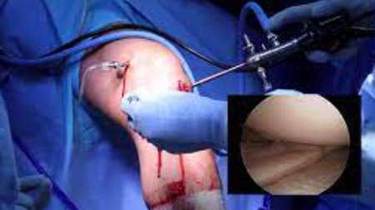 Meniscectomy Surgery in India