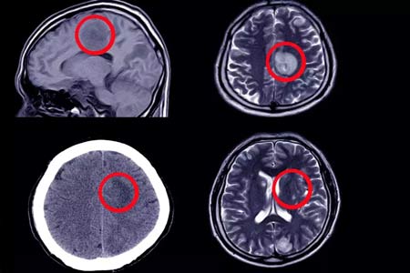 brain aneurysm surgery side effects