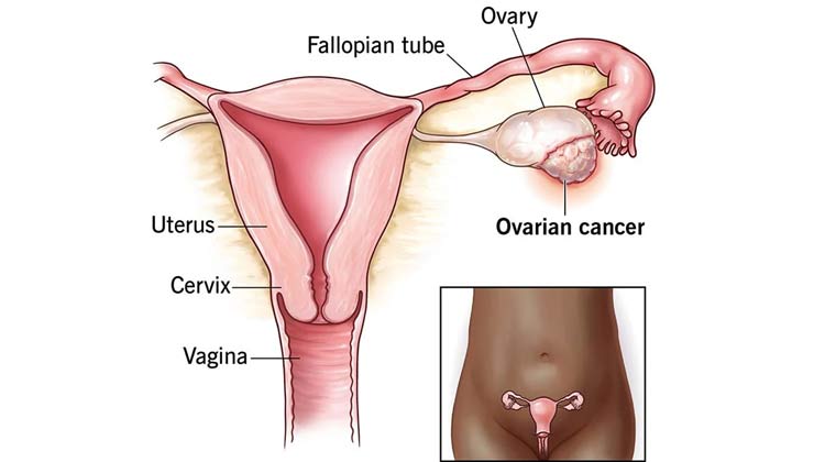Ovarian Cancer Treatment Cost in India