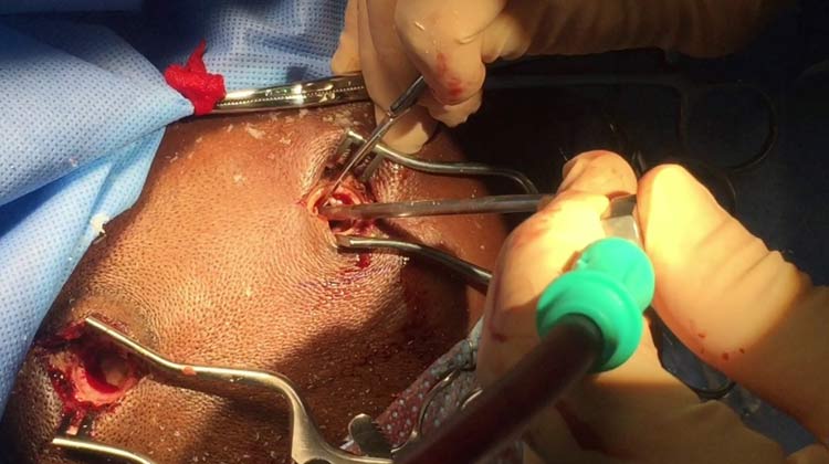 Burr Hole Surgery in India