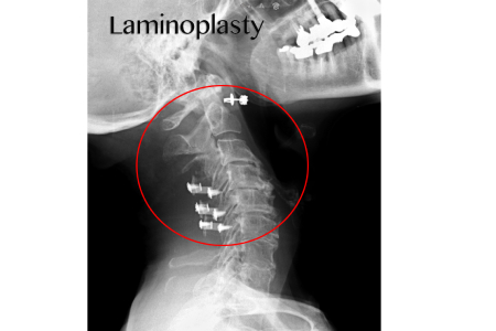 Affordable Laminoplasty Surgery Cost in India