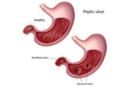 Low Cost Stomach Ulcer Surgery in India