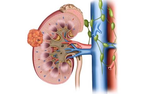 Cost of Radical Nephrectomy in India