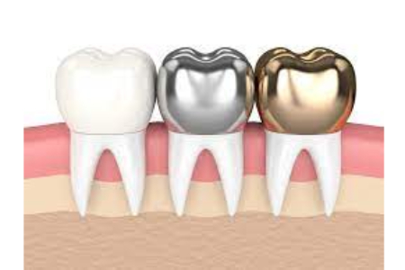 Dental Crown Treatment Cost in India