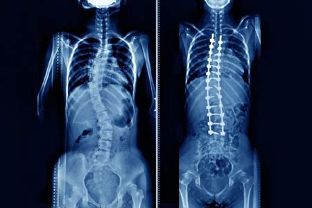 scoliosis surgery  side effects