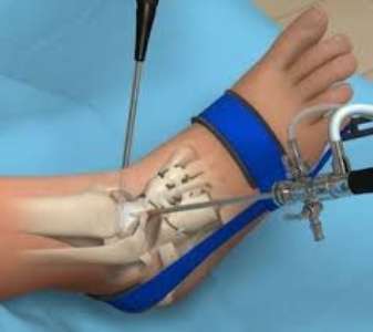 Ankle Arthroscopy Surgery types