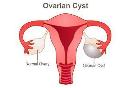 ovarian cyst removal surgery types