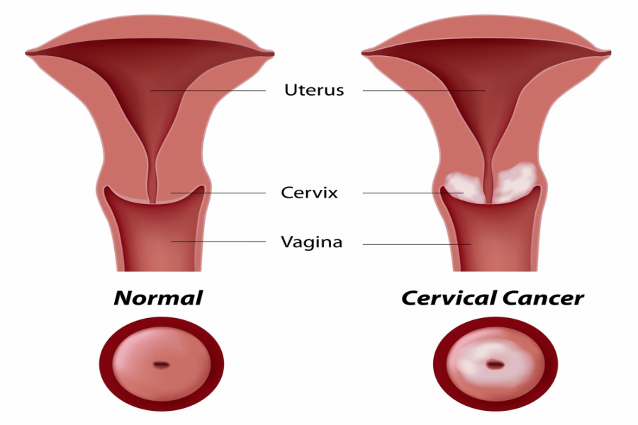 Cost-effective cervical cancer treatment