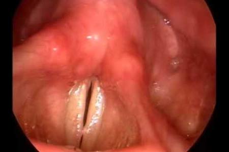 vocal cord treatment before and after