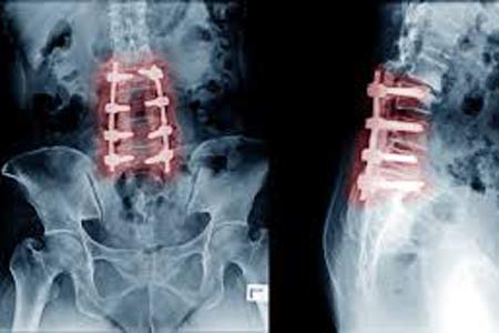 degenerative disc disease surgery before and after