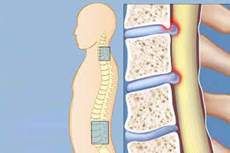 spinal stenosis surgery before and after