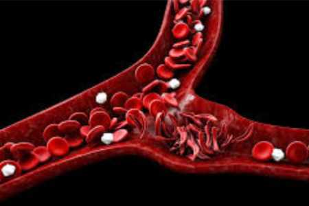 Sickle cell disease  in India