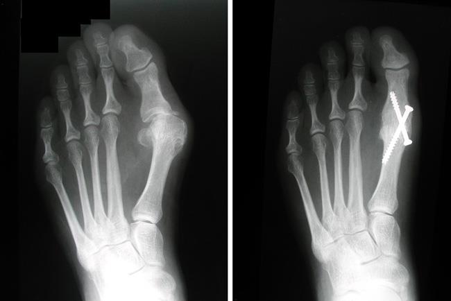 Foot X-ray showing proper alignment after successful bunion surgery