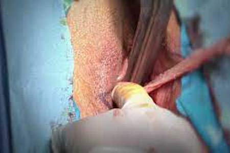 vaginoplasty surgery types